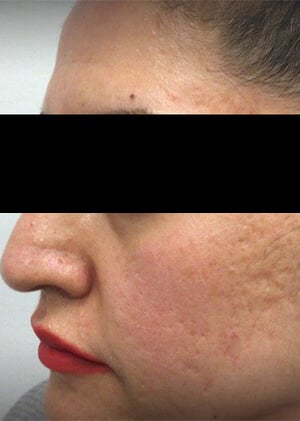 1 acne 1-1