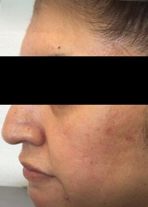 1 acne 2-1
