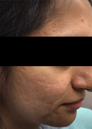 1 marcas acne 1