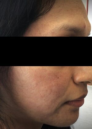 1 marcas acne 2