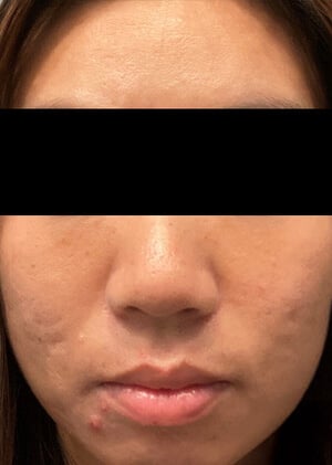 2 marcas acne 1