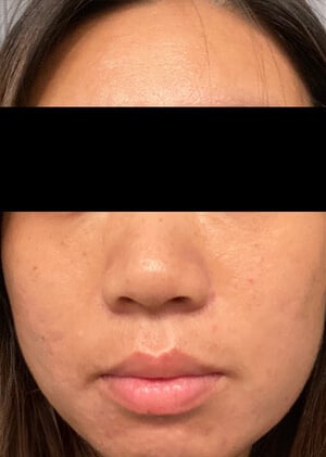 2 marcas acne 2