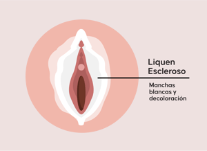Liquen-escleroso