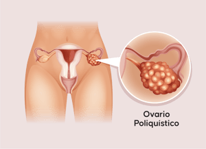 Ovario-poliquistico-v2