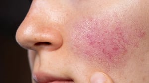Tramientos-para-enrojecimiento-facial-Desktop