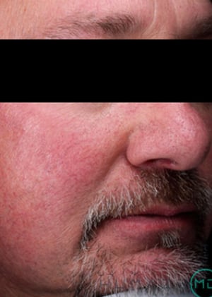 Tramientos-para-enrojecimiento-facial-antes