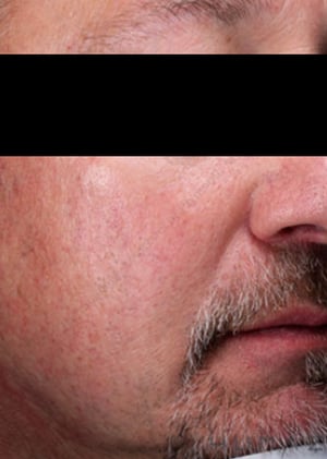 Tramientos-para-enrojecimiento-facial-despues