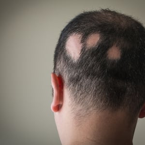 alopecia-o-perdida-de-cabello