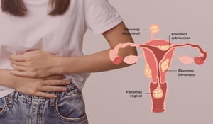 banner-Miomas-Uterinos-sintomas
