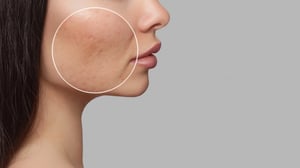 banner-marcas-de-acne-1
