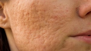 banner-marcas-de-acne-2