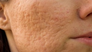 banner-tratamiento-para-marcas-acne
