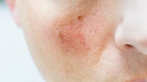 banner-tratamiento-para-rosacea