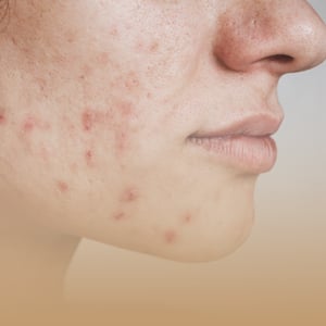 box-dermatologia-imagen-acne