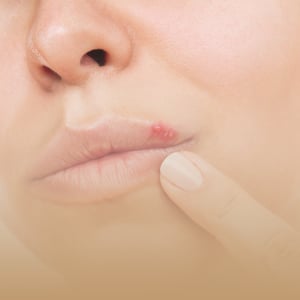 box-dermatologia-imagen-herpes