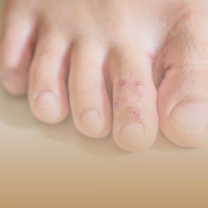 box-dermatologia-imagen-hongos