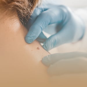 box-dermatologia-imagen-lunares-cancer-de-piel-preventivo
