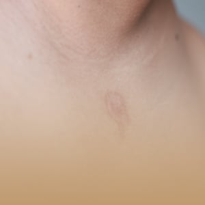 box-dermatologia-imagen-pitiriasis