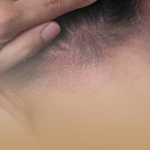 box-dermatologia-imagen-psoriasis