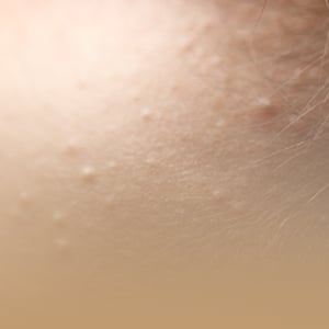 box-dermatologia-imagen-siringomas