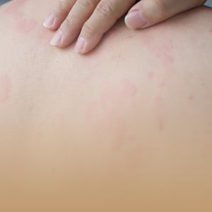 box-dermatologia-imagen-urticaria