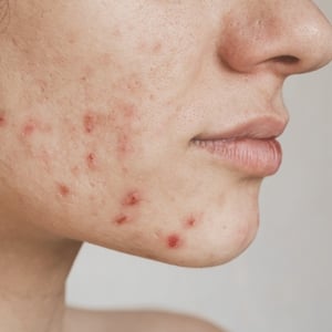 box-imagen-acne