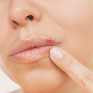 box-imagen-herpes