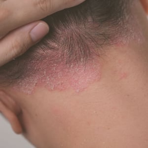 box-imagen-psoriasis