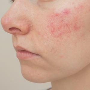 box-imagen-rosacea