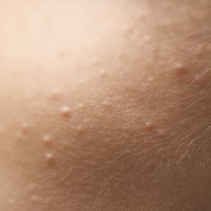 box-imagen-siringomas
