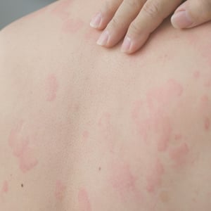 box-imagen-urticaria