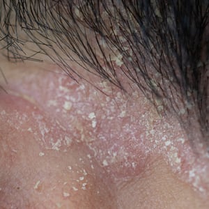 dermatitis-seborreica-v2