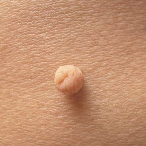 tratamiento-fibromas-cutaneos