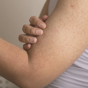 tratamiento-queratosis