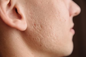 tratamineto-para-enrojecimiento-facial