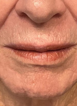 ultraclear_before_and_after_laser_coring_bondi_near_me (1)