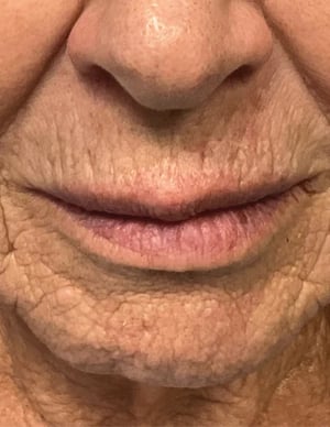 ultraclear_before_and_after_laser_coring_bondi_near_me