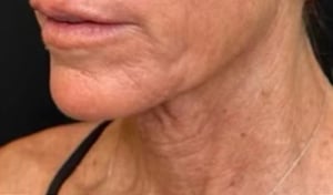 ultraclear_neck_laser_coring_before_and_after_neck_skin_tightening (1)