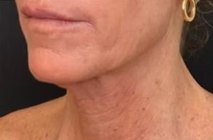 ultraclear_neck_laser_coring_before_and_after_neck_skin_tightening